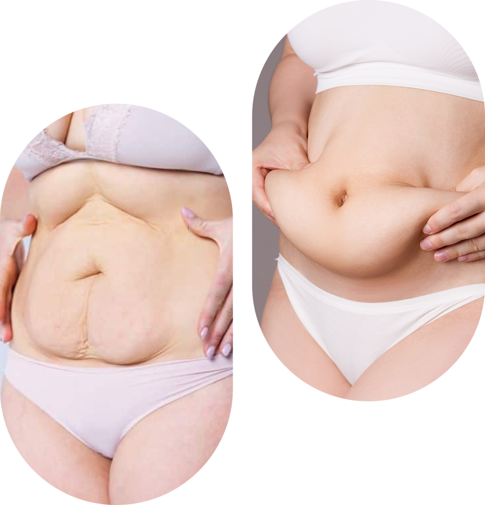 Abdominoplastie en Tunisie avant après