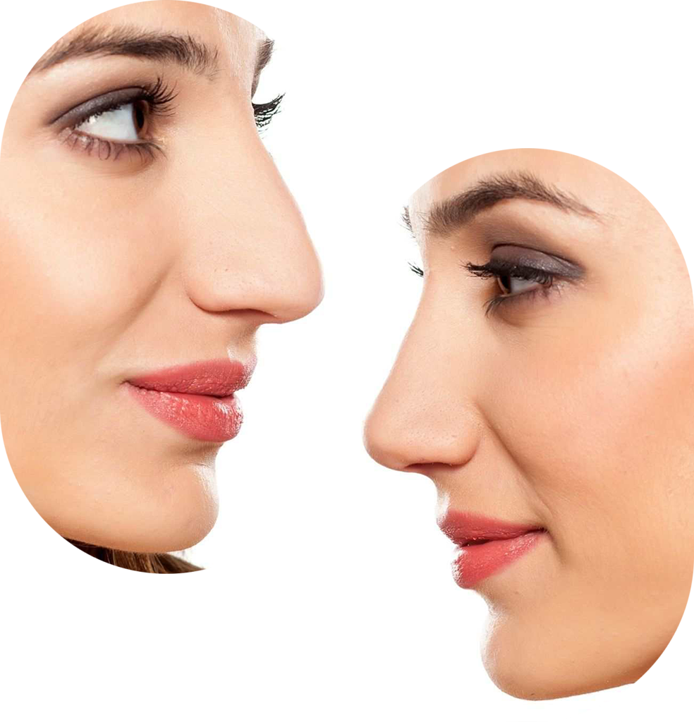 prix Rhinoplastie Tunisie