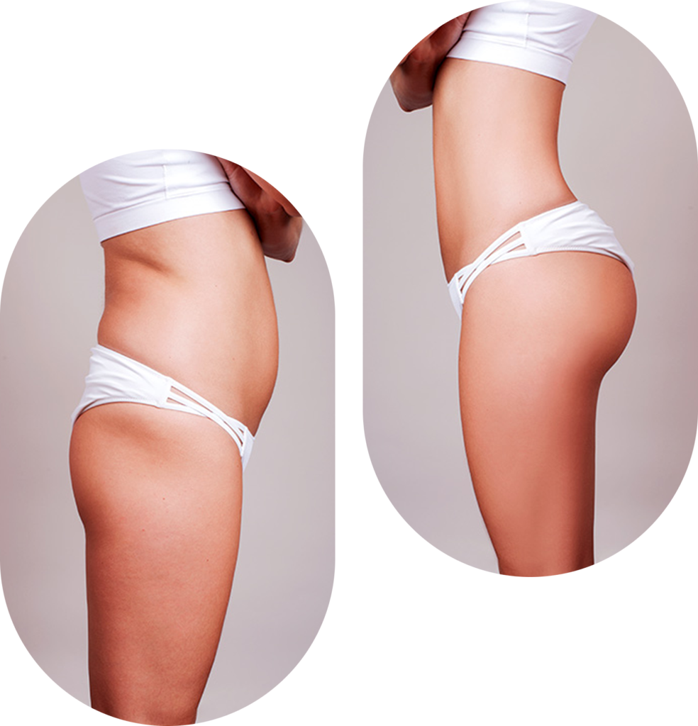 Lipofilling fessier en Tunisie