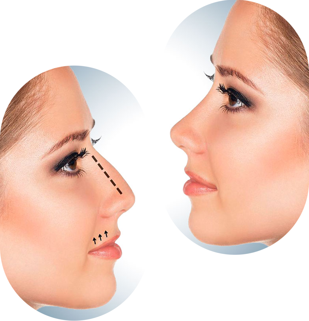 prix Rhinoplastie Tunisie