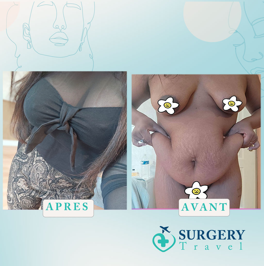 Abdominoplastie en Tunisie avant après