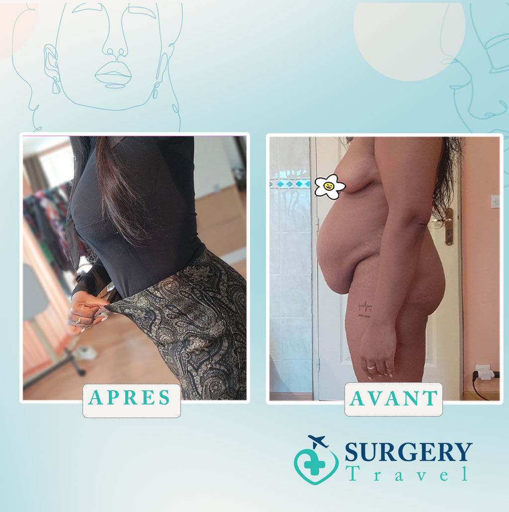 Abdominoplastie en Tunisie avant après