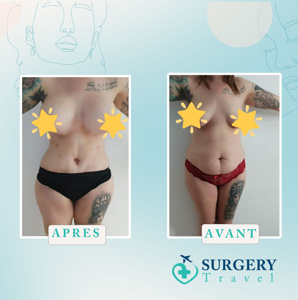 Abdominoplastie en Tunisie avant après